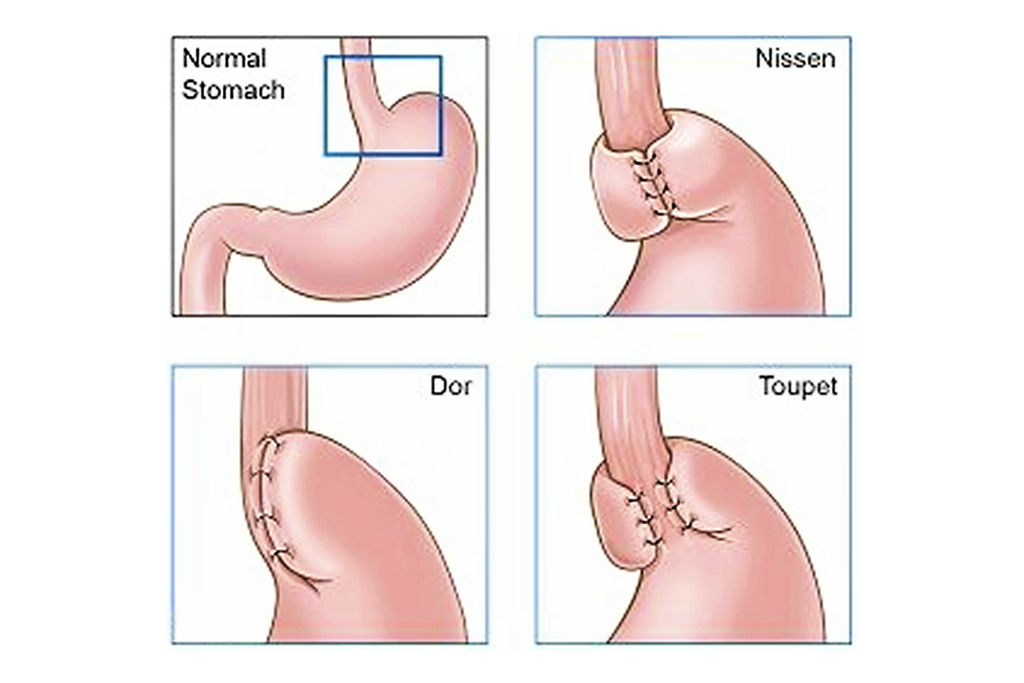 Gastric Hernia Surgery